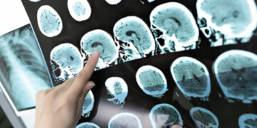 Nuevas pistas para la identificación temprana de Alzheimer