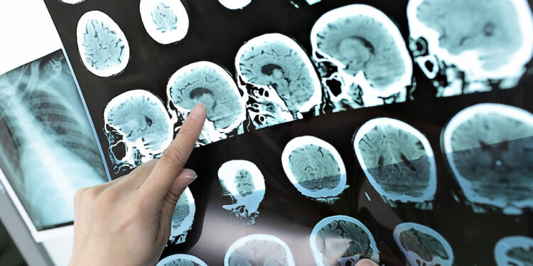 Nuevas pistas para la identificación temprana de Alzheimer