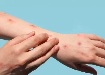 El Gobierno refuerza medidas ante los casos de viruela del mono en Argentina