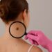 Tecnología y prevención: Claves para detectar a tiempo el melanoma, el cáncer de piel más agresivo