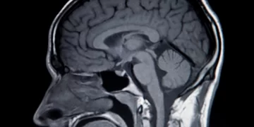 Implante cerebral permite a un hombre con ELA hablar y cantar con su “voz real”