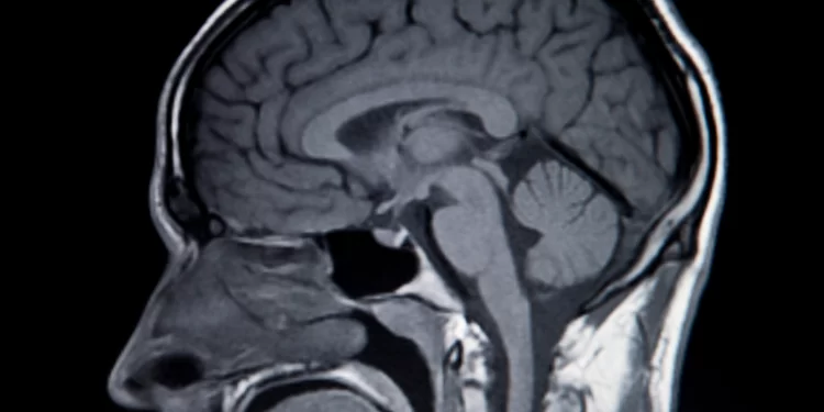 Implante cerebral permite a un hombre con ELA hablar y cantar con su “voz real”