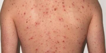 Confirmaron el primer caso de sarampión del año en Argentina